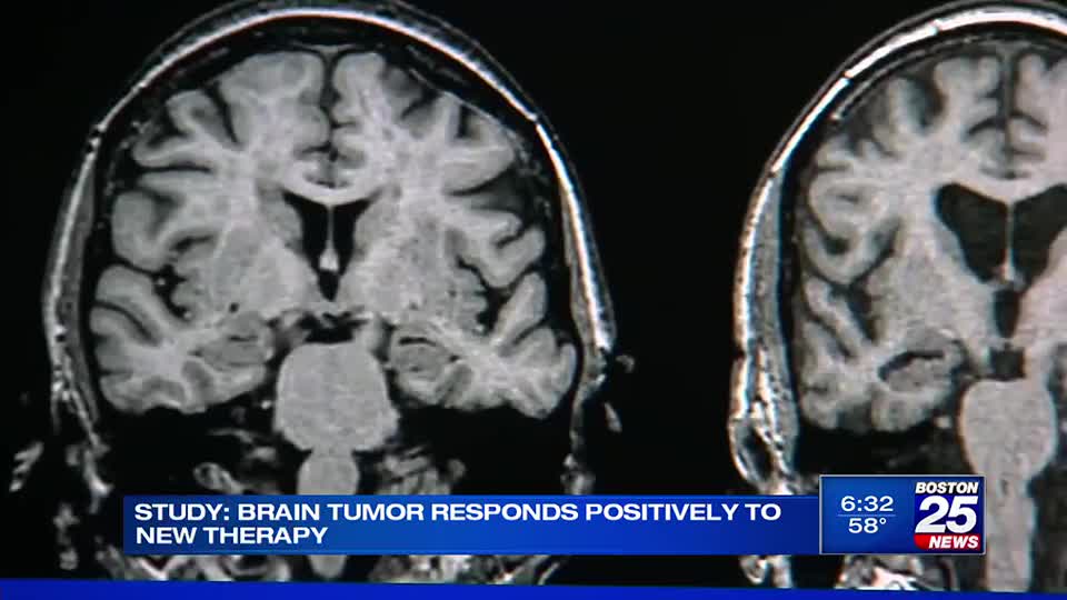Deadly brain tumor responds positively to new therapy, Boston 