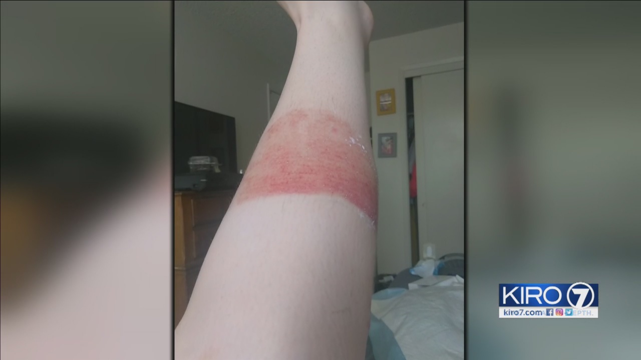 Pierce County woman sues over e-cigarette explosion - KIRO 7 News Seattle