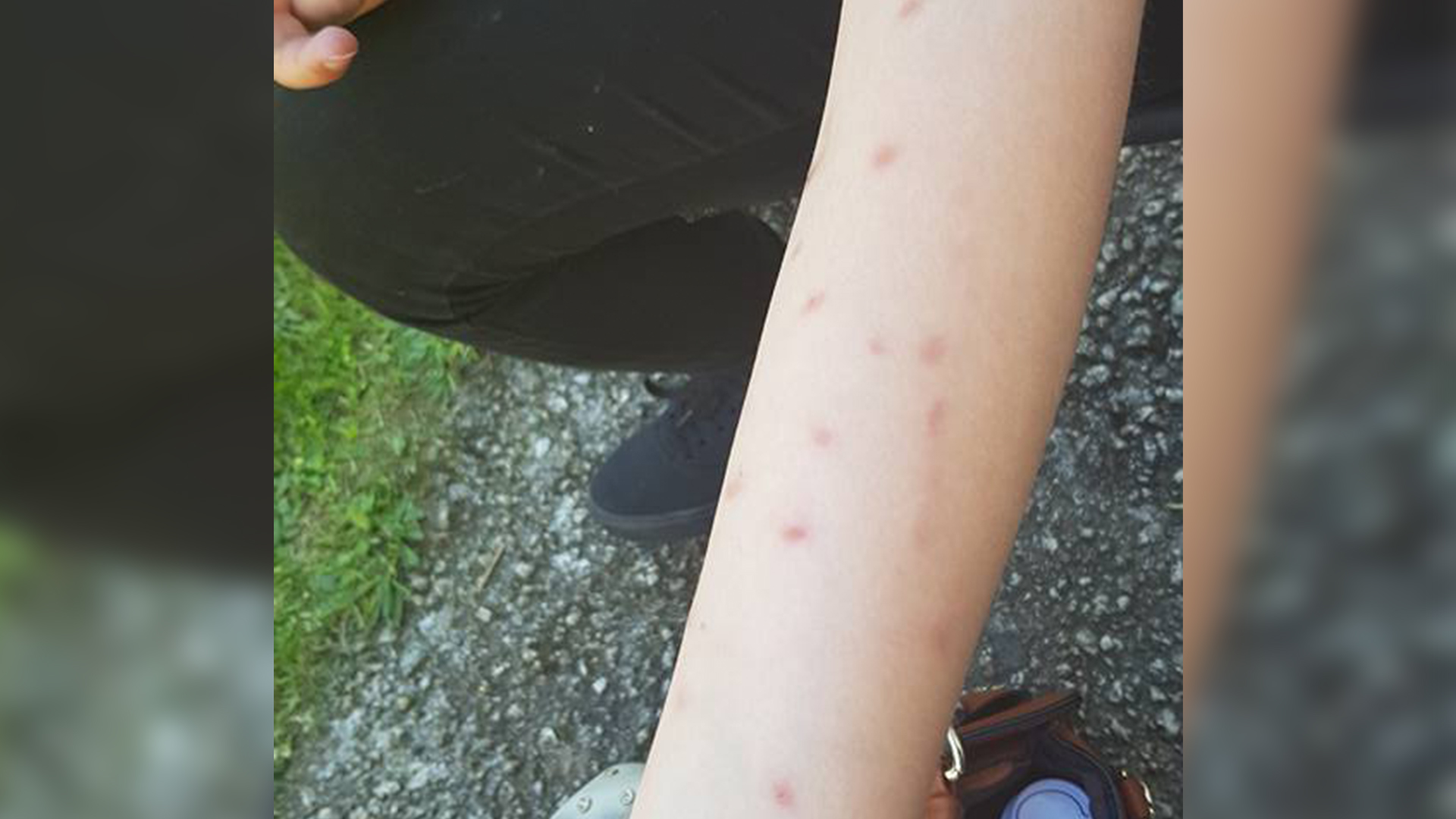 Mom claims ‘deodorant challenge' left her daughter with seconddegree burns