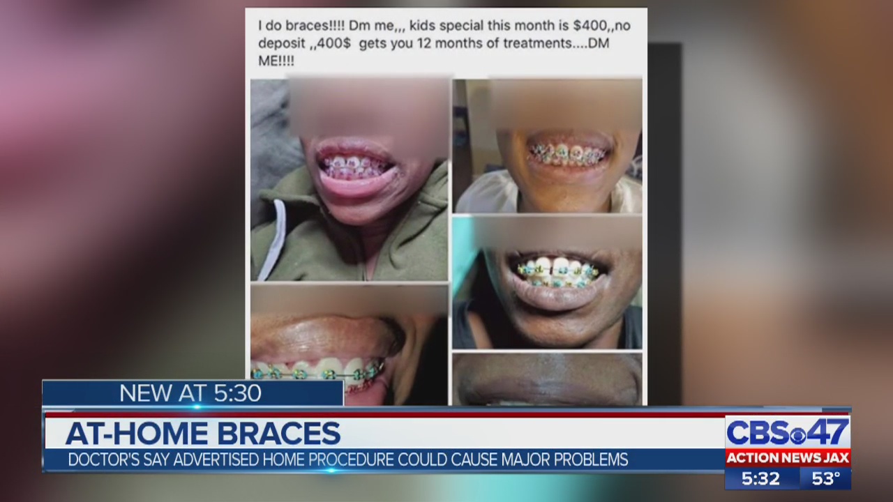 Woman advertises athome braces in Jacksonville Facebook group Action
